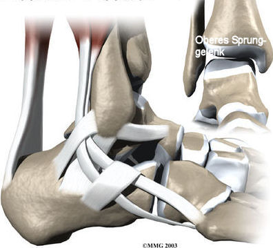 Arthrose Des Sprungelenkes | Fuss & Sprunggelenk | Orthozentrum ...